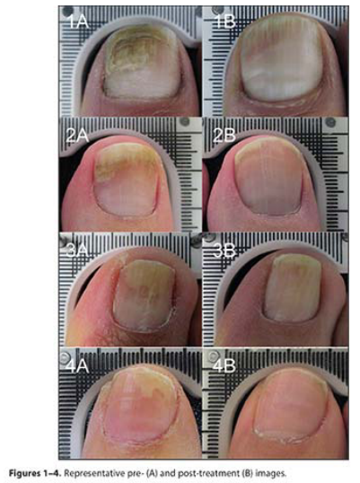 Cure Nail Fungus Infection Using Cold Laser Technology in New Zealand