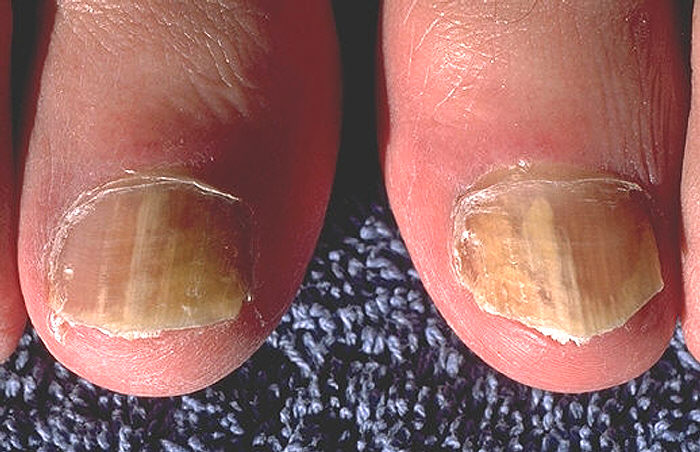 Toenail Fungus