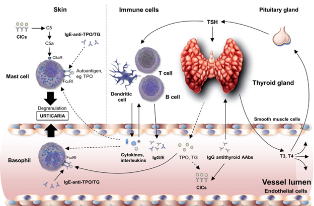 Thyroid autoimmune mechanisms in chronic spontaneous urticaria

