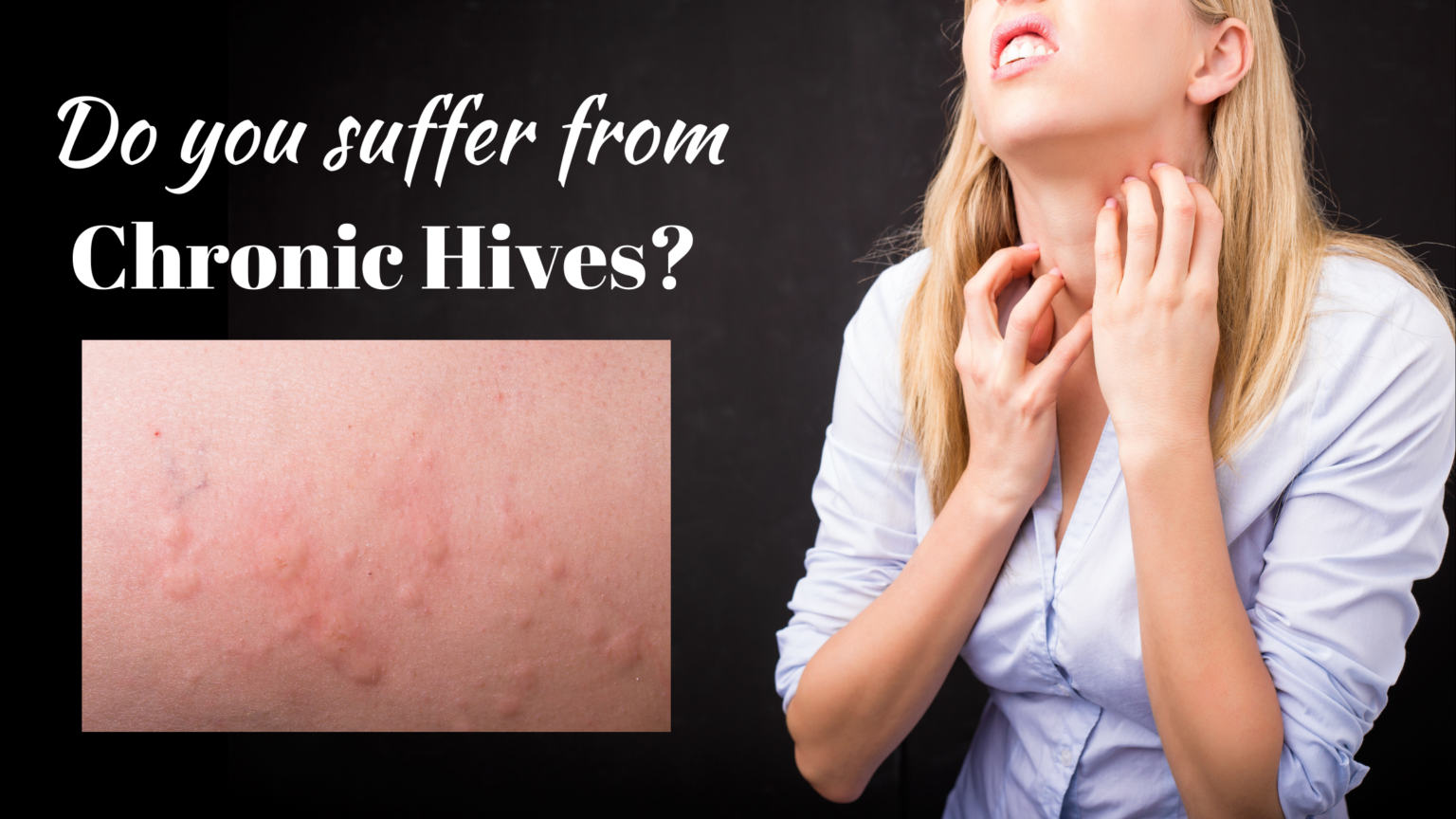 Are Chronic Hives Related To Autoimmune Thyroid Disease